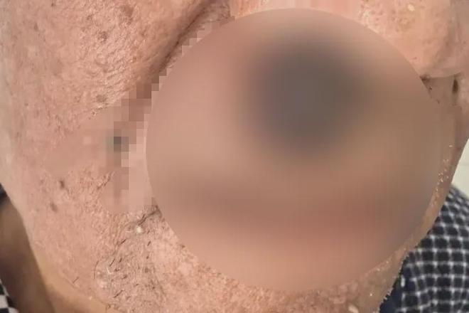 男子癌症晚期全身恶臭！上海专家婉拒手术：风险极大又无法延命但因一句话决定迎难而上→(图1)